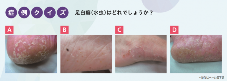 特集 白癬の〝真〞常識 | ファーマスタイルWEB