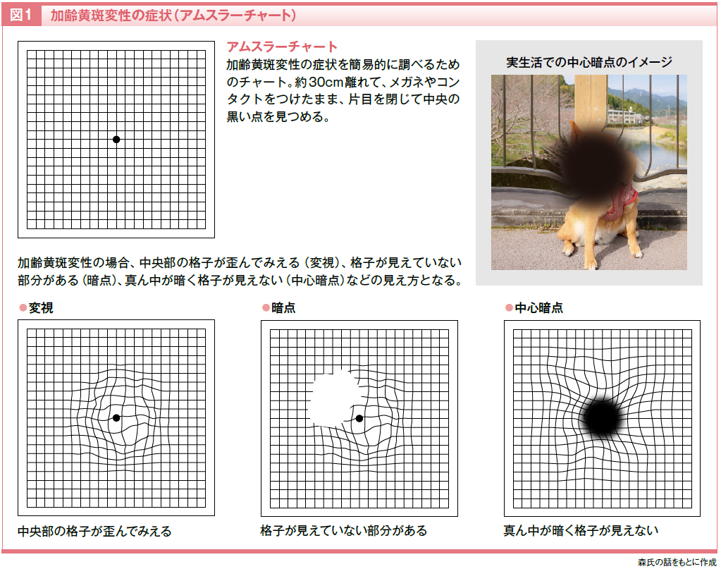 特集】加齢黄斑変性の基礎知識 | ファーマスタイルWEB